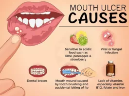 Mouth ulcers