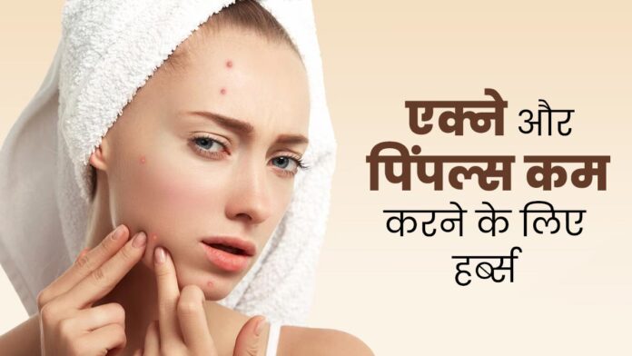 एक्ने और पिंपल्स